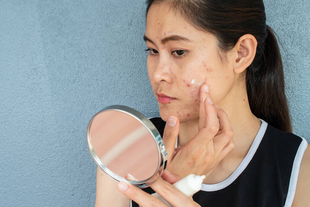 Portret van Aziatische vrouw zorgen te maken over haar gezicht toen ze zag het probleem van acne ontsteking en litteken door de minispiegel. Conceptuele shot van Acne & Probleem Huid op vrouwelijk gezicht. - Foto, afbeelding