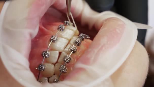 Nierozpoznawalny pacjent z aparatem na zęby - Materiał filmowy, wideo
