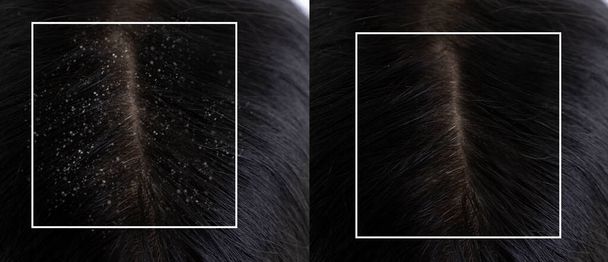 korpásodás a haj kezelés előtt és után - Fotó, kép