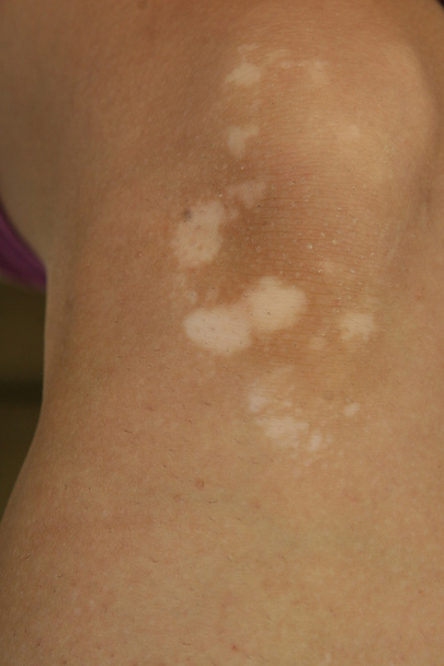 Колено с заболеванием кожи витилиго
 - Фото, изображение