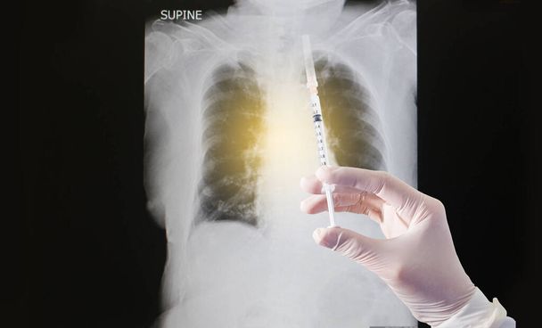 Los médicos están preparando medicamentos y vacunas para inyectar al paciente. comparación de rayos X de pulmón  - Foto, imagen