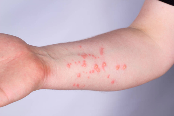 Large rash on the guy's hand. Monkeypox virus - Fotoğraf, Görsel