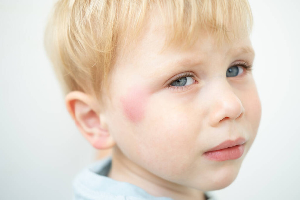 retrato de niño pequeño con la mancha roja alérgica en la cara causa por picadura de mosquito - Foto, Imagen