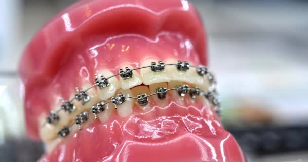Ιμάντες σε τεχνητά δόντια από κοντά. Οδοντιατρική οδοντιατρική. Προστατευτικά δοντιών. - Πλάνα, βίντεο