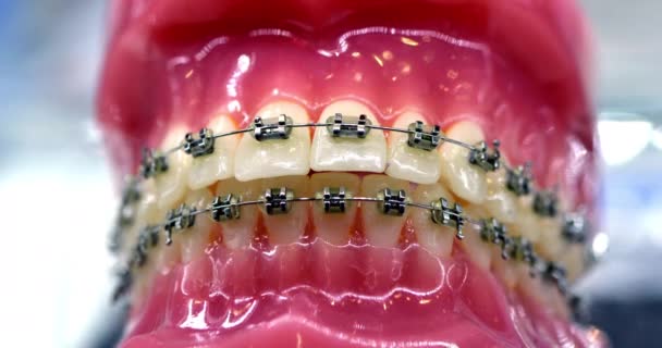 Beugels op kunstmatige tanden close-up. Tandheelkunde. Tandbeugels. - Video