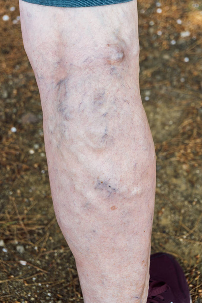 Close-up zicht op de benen van een man met spataderen als gevolg van een defect in de bloedsomloop - Foto, afbeelding