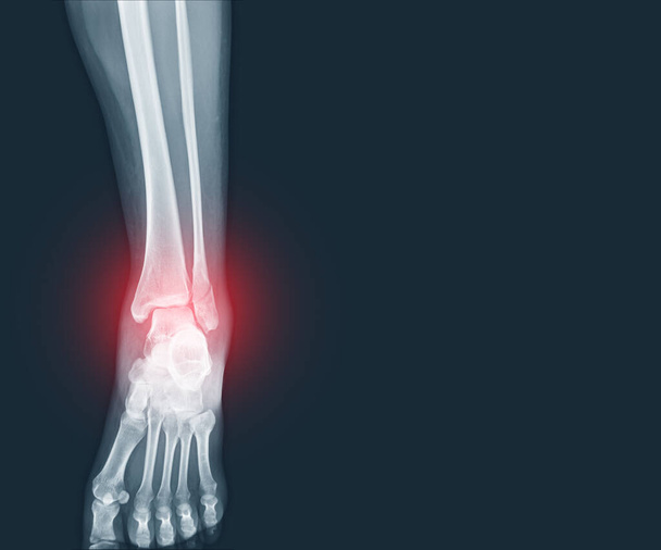 フィルムX線足首と足骨折赤色の市場に腫れ軟組織と遠位繊維骨。医療の概念. - 写真・画像