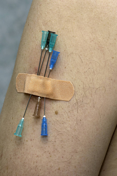 concepto de vacunación revacunación varias agujas de las jeringas se clavan en el brazo de una persona y se sellan con un parche médico. Foto de alta calidad - Foto, Imagen