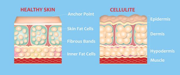 Tvorba podkožní celulitidy ilustrace. Struktura normální zdravé a celulitidy kůže. Porovnání - Fotografie, Obrázek