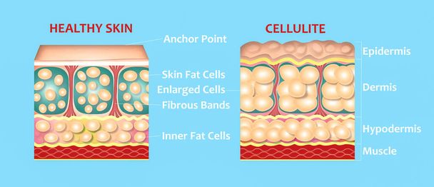 Formación de ilustración de celulitis bajo la piel. Estructura de la piel normal sana y celulitis. Comparación - Foto, Imagen
