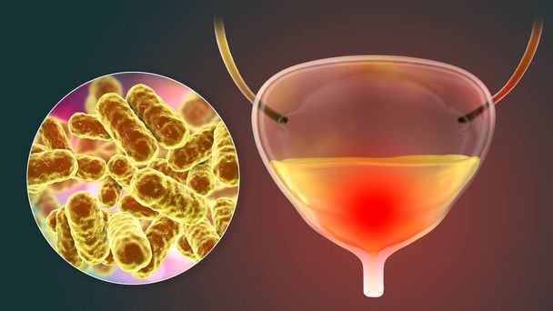 膀胱炎,膀胱の細菌感染,尿中の細菌を示す概念的な3Dイラスト - 写真・画像