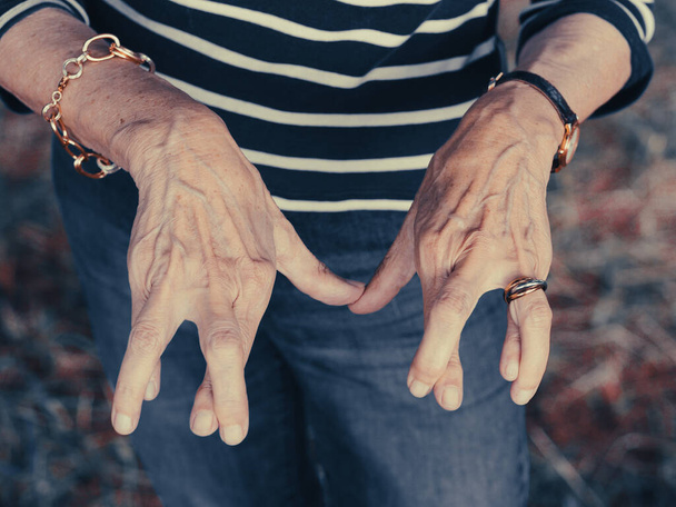 A senior lady hands -arthritis, aging - Photo, Image