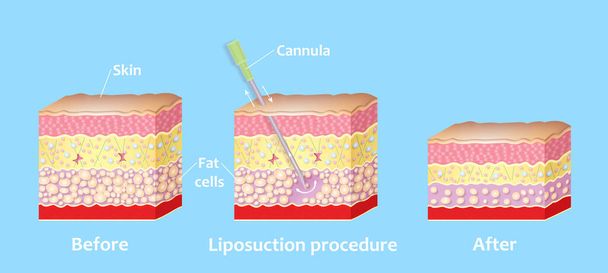 Mechanism of liposuction. Suction-assisted liposuction. Hollow tube or cannula, which is inserted through a small incision in the skin in order to fat suctioned out of the body - Photo, Image