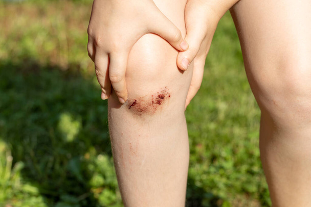 ребенок, девочка или мальчик держатся за раненое колено на улице в солнечный летний день - Фото, изображение