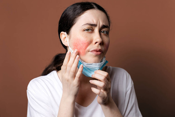 Maskne. Portret młodej białej zdenerwowanej kobiety pokazuje podrażnienie na policzkach po założeniu maski ochronnej. Brązowe tło. Pojęcie trądziku różowatego i alergii. - Zdjęcie, obraz