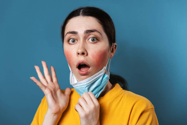 Maskne. Portrait of a young amazed woman shows irritation on her cheeks from wearing a protective mask. Blue background. The concept of rosacea and allergies. - Photo, Image