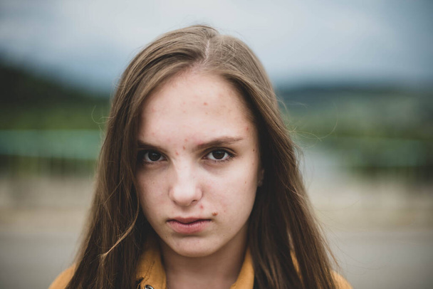 Portrait of young beautiful cute teenage girl woman with frackles and problematic skin on natural background. Girl power, body positive, real people. - Photo, Image
