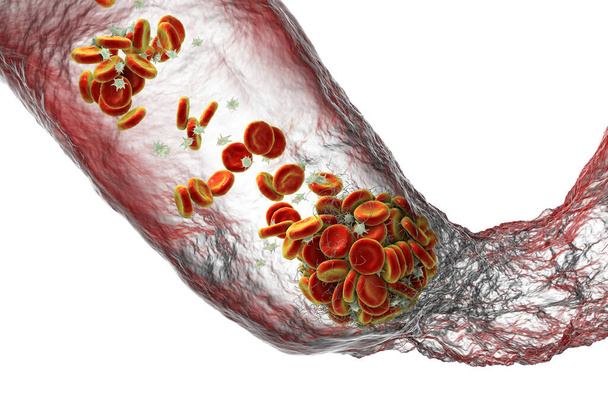 Blood clot made of red blood cells, platelets and fibrin protein strands. Thrombus, 3D illustration. Thrombosis, thromboembolism, blood clotting - Photo, Image