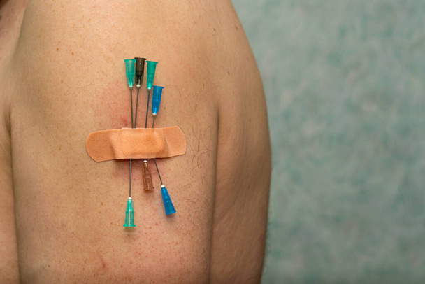 Bei der Impfung werden mehrere Nadeln aus Spritzen in den Arm einer Person gesteckt und mit einem medizinischen Pflaster versiegelt. Hochwertiges Foto - Foto, Bild