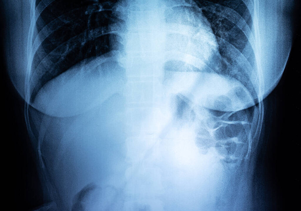 Filme X-ray mama e abdômen de uma pessoa  - Foto, Imagem