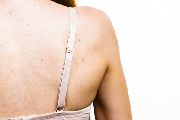 Health problem, skin diseases. Young woman showing her back with acne, red spots. Teen girl with many pimples. - Fotó, kép