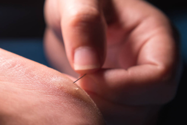 Women's fingers pierce a callus on the heel with a needle. Close-up - 写真・画像