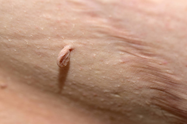 El papiloma se encuentra en el abdomen del hombre junto a la sutura quirúrgica. - Foto, imagen