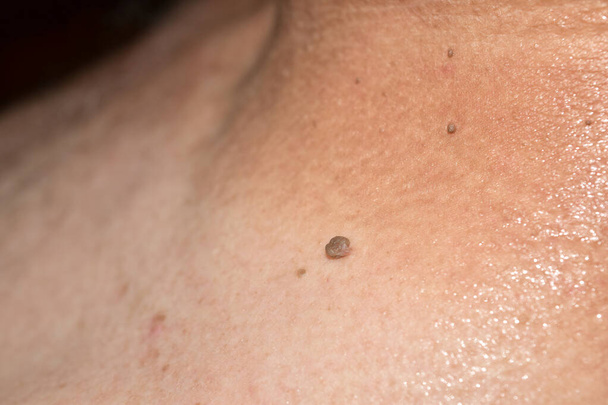 Papillome situé sur le cou d'un homme. - Photo, image