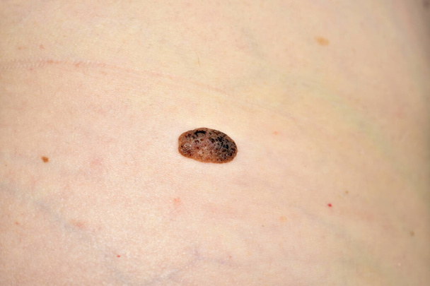 Close-up van een grote moedervlek aan een vrouwenzijde. - Foto, afbeelding