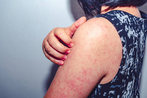 Measles, Women scratch the upper arm with one hand due to the numerous red pruritus., Measles is a disease that can spread easily. - Photo, Image