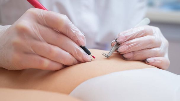 The doctor does electro epilation of the bikini zone to a woman in the salon. An alternative way to permanently remove unwanted body hair - Foto, Imagen