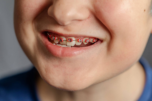 dientes de un adolescente con frenos de cerca. Concepto de higiene bucal y atención sanitaria - Foto, Imagen