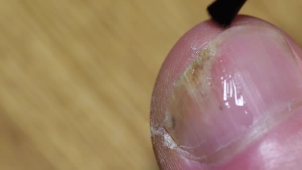 La aplicación de la solución de uñas con un cepillo. Infecciones de uñas causadas por hongos. - Imágenes, Vídeo