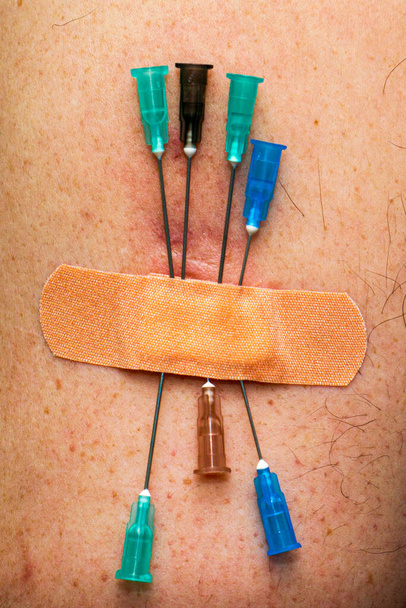 concept vaccination revaccination plusieurs aiguilles de seringues sont collées dans le bras d'une personne et scellées avec un patch médical. Photo de haute qualité - Photo, image