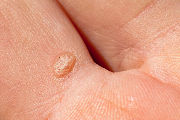 Brodawka zwyczajna, Verruca vulgaris, na palcu białej ręki ludzkiej, kosmetyczne zakażenie dermatologiczne spowodowane wirusem brodawczaka hpv - Zdjęcie, obraz