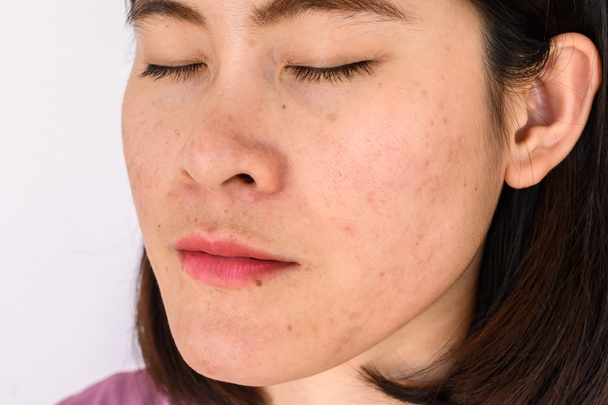 Side view close-up van het gezicht van de vrouw heeft verschillende problemen op haar huid (zoals acne, puistjes, poriën en melasma etc). Conceptueel van natuurlijk probleem op de huid van de vrouw. - Foto, afbeelding