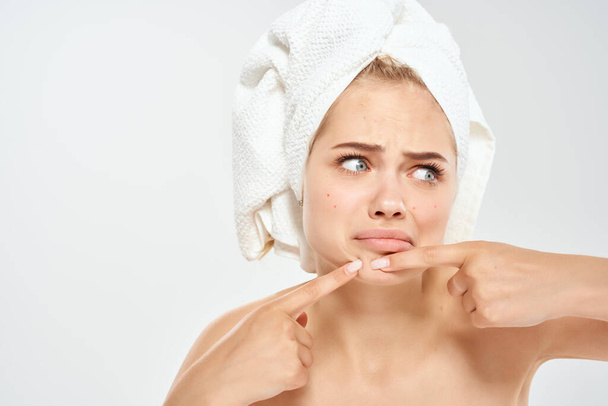 γυναίκα με μια πετσέτα στο κεφάλι της πιέζει τα σπυράκια στο πρόσωπό της καθαρή υγεία του δέρματος - Φωτογραφία, εικόνα