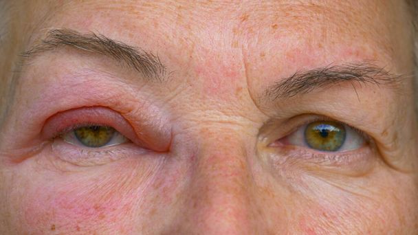 CLOSE UP: Kaukasierin mit infiziertem und geschwollenem Auge blickt in die Kamera. - Foto, Bild