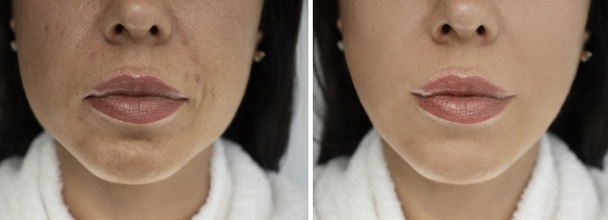 морщины лица женщины до и после лечения - Фото, изображение