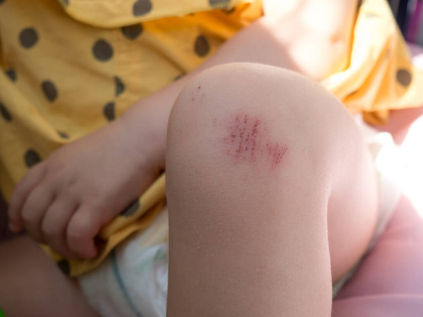 Рана на ноге ребенка. Упал на дороге. ссадины на колене ребенка крупным планом - Фото, изображение