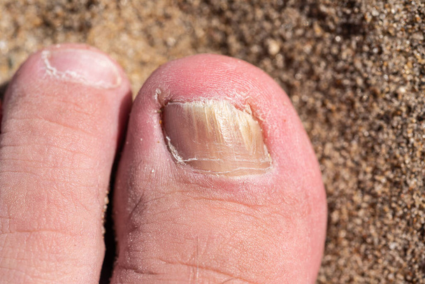 Fungus on the toenail of a man's toe, close-up on the sand - Photo, Image