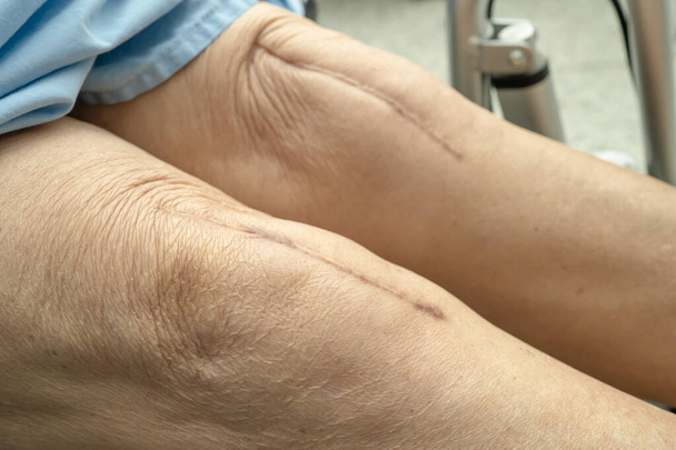 Asiatische Seniorin oder ältere Patientin zeigt ihre Narben Chirurgischer Gesamt-Kniegelenkersatz Nahtwundchirurgie Arthroplastik am Bett auf der Krankenstation, gesundes starkes medizinisches Konzept. - Foto, Bild