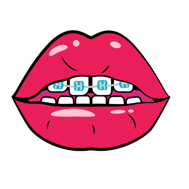 Bouche ouverte rouge avec bretelles sur les dents - Photo, image