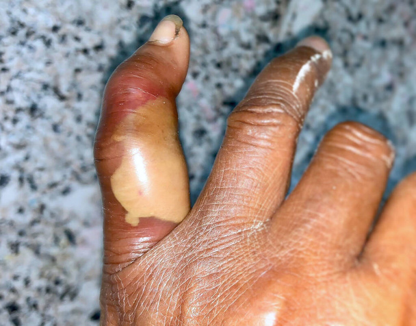 Absceso con celulitis circundante o infección de piel estafilocócica / estreptocócica en el dedo medio del paciente masculino asiático birmano. - Foto, imagen