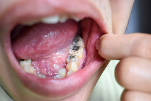 Ασημένια σφραγίσματα αμαλγάματος στο κάτω δεξί μέρος του πρώτου τραπεζίτη και στο κάτω αριστερό κάτω μέρος του δεύτερου προγομφικού δοντιού σε ασιατικό, νεαρός άνδρας. Οδοντιατρική τερηδόνα είναι επίσης παρόντες δείχνουν κακή στοματική υγιεινή. - Φωτογραφία, εικόνα