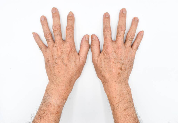 Věkové skvrny na rukou asijského staršího muže. Jsou to hnědé, šedé nebo černé skvrny a také nazývají jaterní skvrny, senilní lentigo, solární čočky, nebo sluneční skvrny. Izolováno na bílém pozadí. - Fotografie, Obrázek