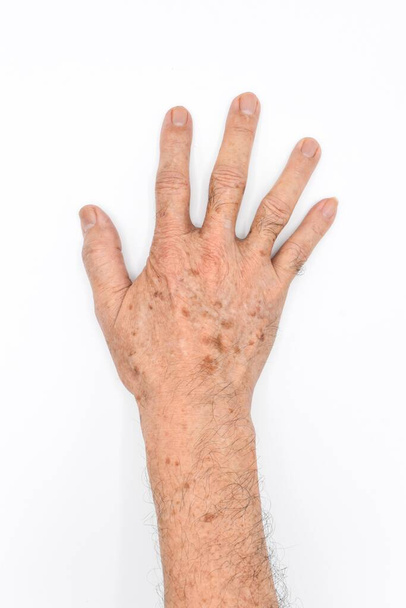 Kor foltok az ázsiai öregember jobb kezén. Ezek barna, szürke, vagy fekete foltok és az úgynevezett májfoltok, szenilis lencse, vagy napfoltok. Az első ember megnézi. Fehér alapon elszigetelve. - Fotó, kép