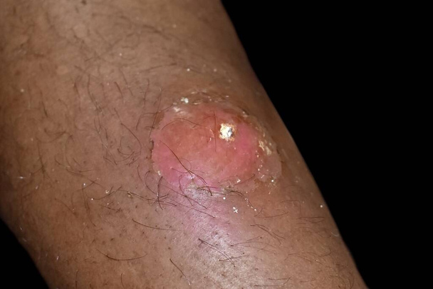 Abcesso iminente com celulite circundante ou infecção cutânea estafilocócica / estreptocócica na perna direita do paciente masculino birmanês asiático. Vista lateral. - Foto, Imagem