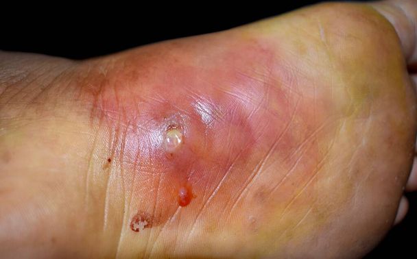Versehentliche Nagelstichverletzung am Fuß eines südostasiatischen Patienten. Cellulitis und drohender Abszess. Geschwüre bei Diabetes. Tetanus-Impfstoff sollte angewendet werden. - Foto, Bild