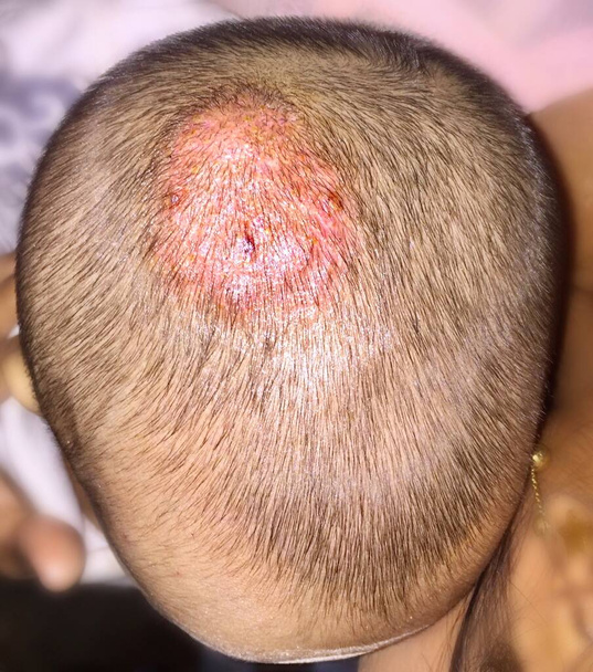 治療された白癬または東南アジアの頭皮に真菌感染症,診療所でビルマ2歳の子供 - 写真・画像